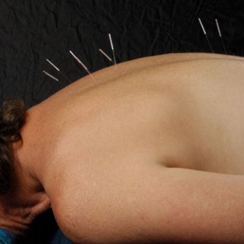 Acupuntura – referente ao julgamento do TRF